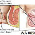 Obat Ambeien Luar (Eskternal) Bentuk Salep thumbnail