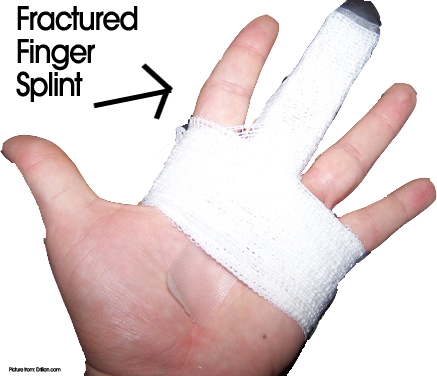 finger fracture broken fractured jammed