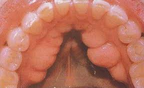 Bump On Gums In Mouth 107