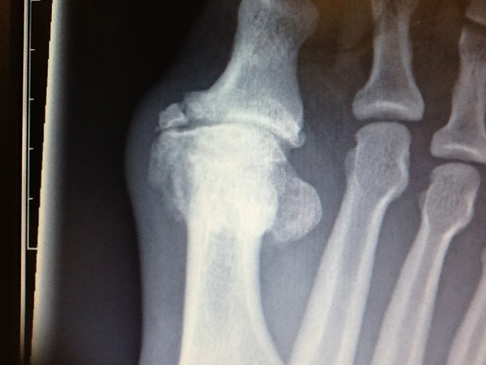Foot and Ankle Problems By Dr. Richard Blake Bone Spur on the Big Toe