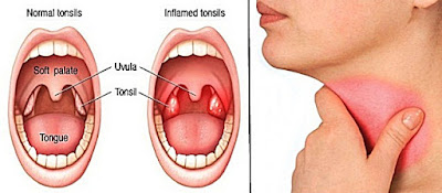 http://www.titik-pijat.com/2017/12/obat-radang-tenggorokan.html