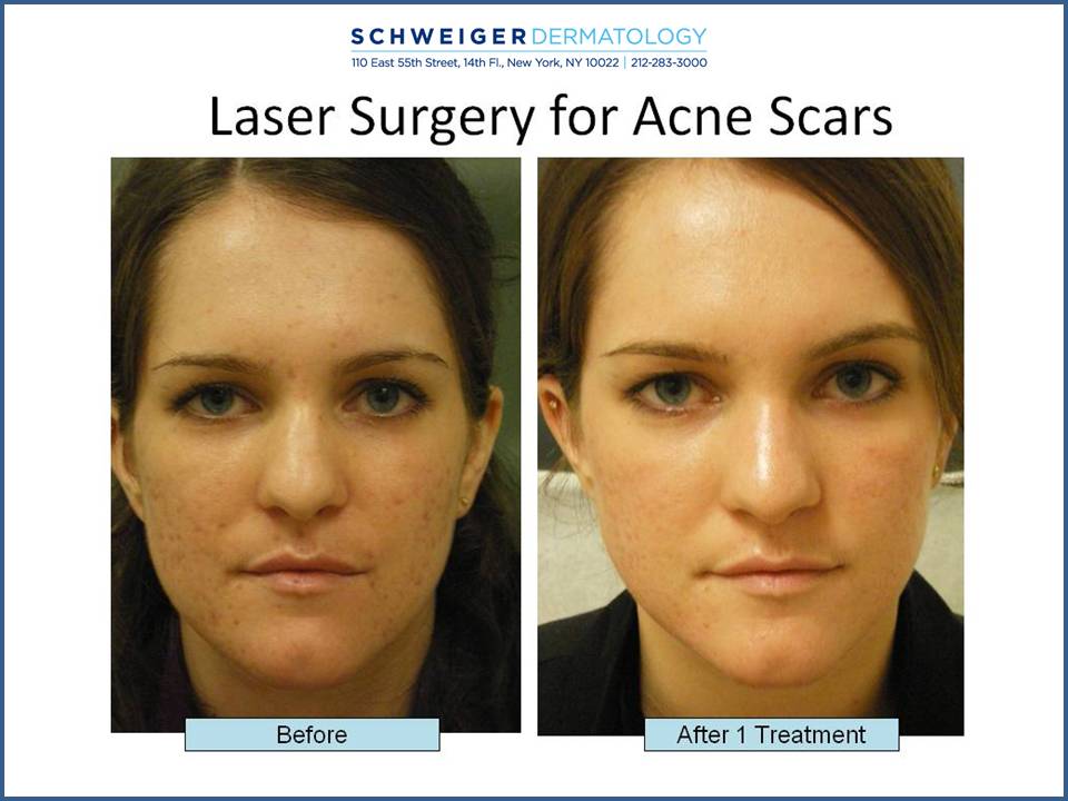 Laser Acne Scar Removal 