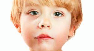 annesi ve bebegi cocuklarda dudak catlagi dudak kurumasi ne iyi gelir