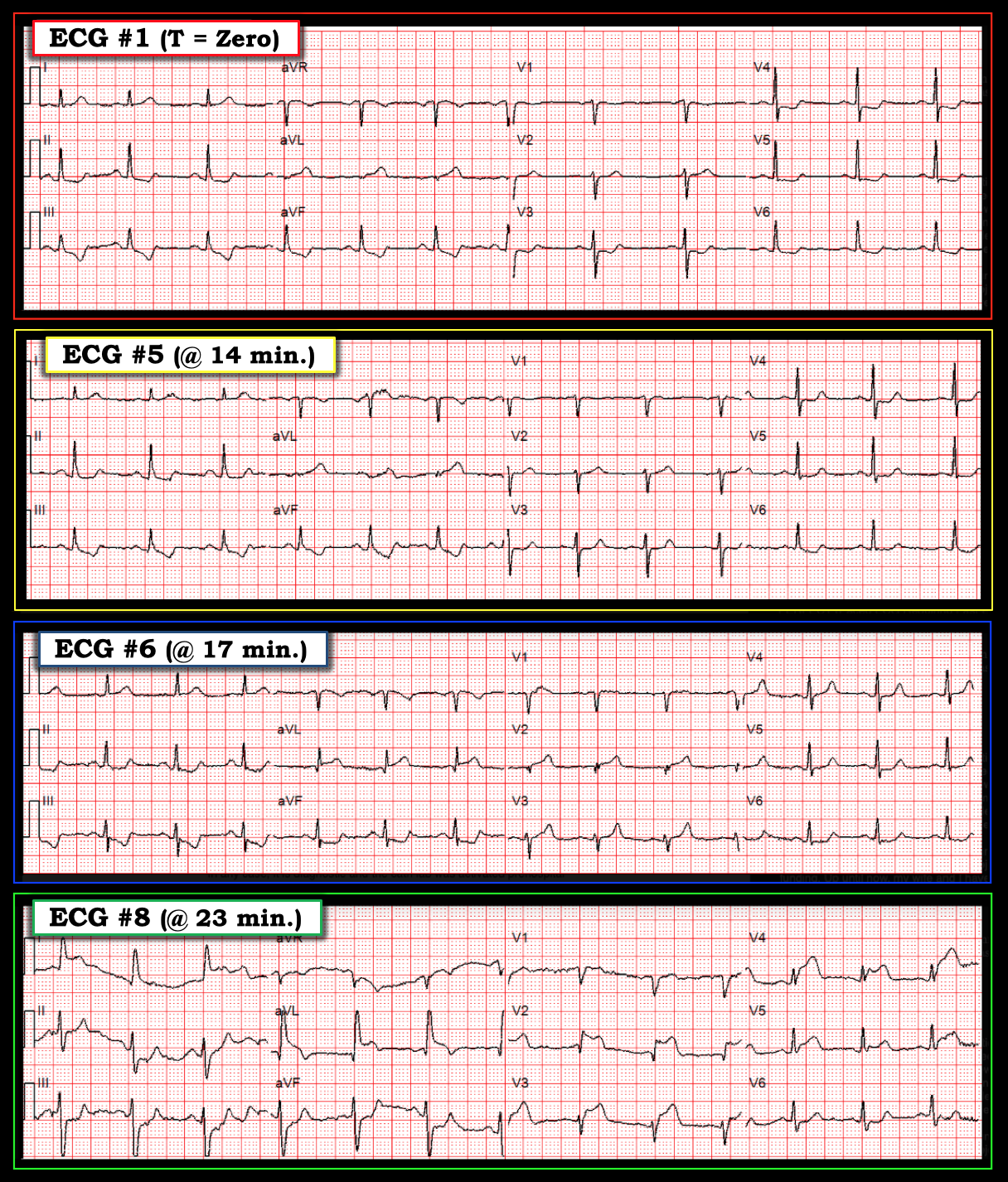 Dr. Smith's ECG Blog Thrombus propagation on 10 serial Prehospital