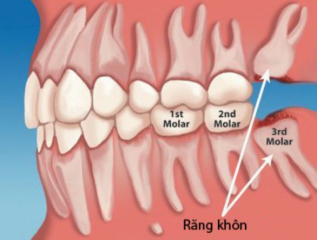  nhổ răng khôn uy tín