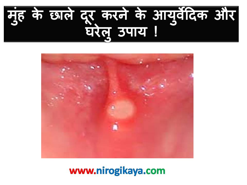 मुंह के छाले (Mouth Ulcer) दूर करने के आयुर्वेदिक और घरेलु उपाय