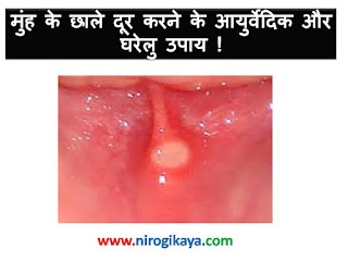 ayureveda-home-remedies-treatment-mouth-ulcer-in-hindi