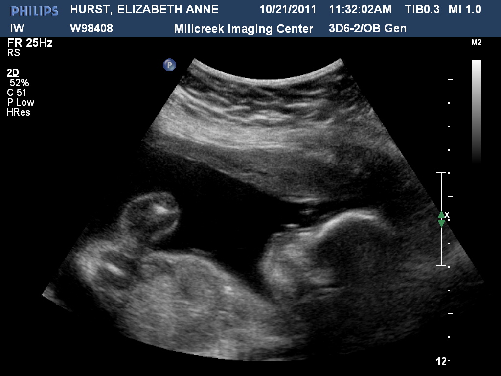 The Hurst Family: Some Ultrasound Pics of our Baby Boy