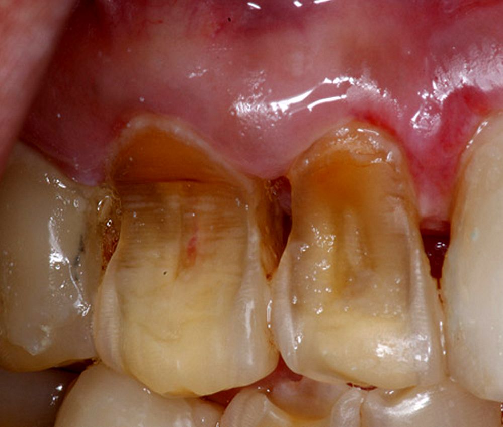 ORAL MEDICINE Erosive Tooth Wear Directorio Odontológico