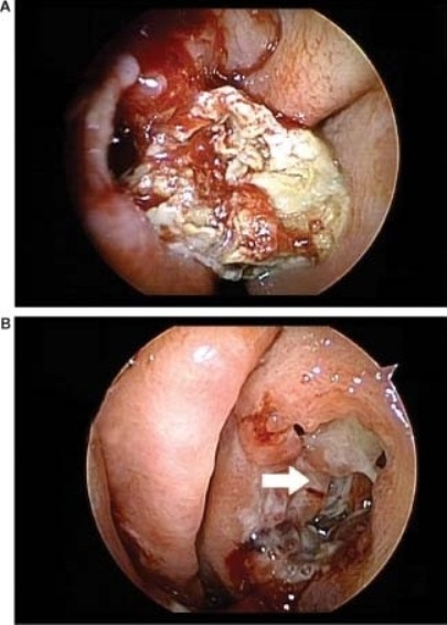 117 Perforation De Cloison Et Mycose Sinusienne Forum Institut