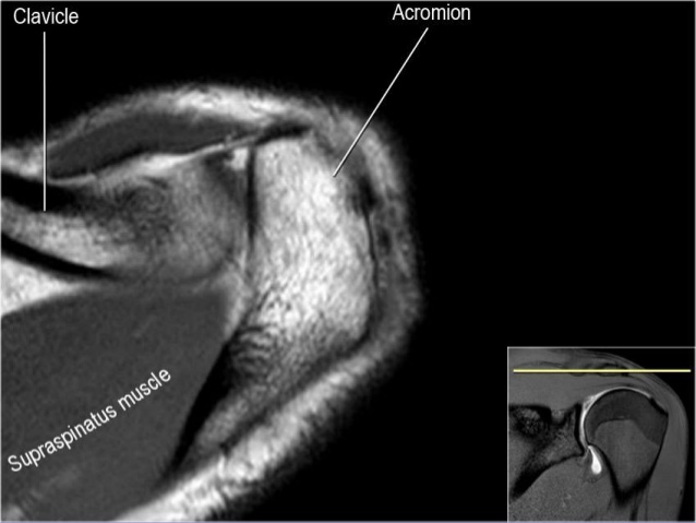 MRI Musculo-Skeletal Section: MRI anatomy of the shoulder (axial view)