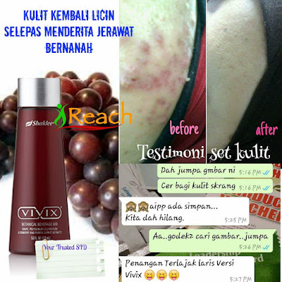 testimoni vivix jerawat bernanah testimoni vivix jerawat bernanah