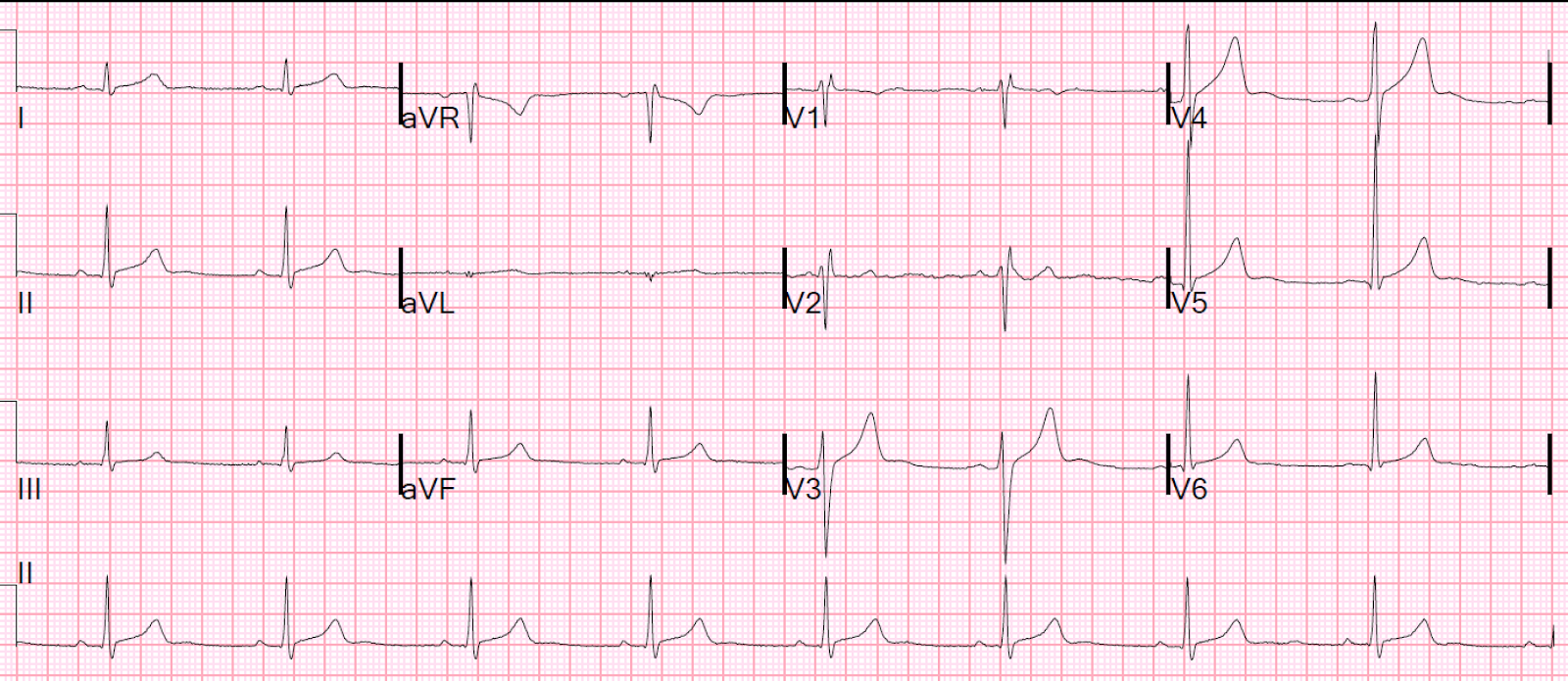 Dr. Smith's ECG Blog Palpitations in a Young Healthy Male