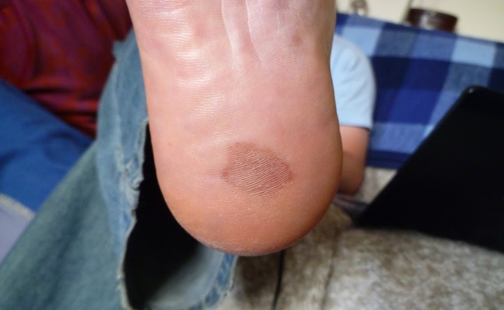 bruised heel