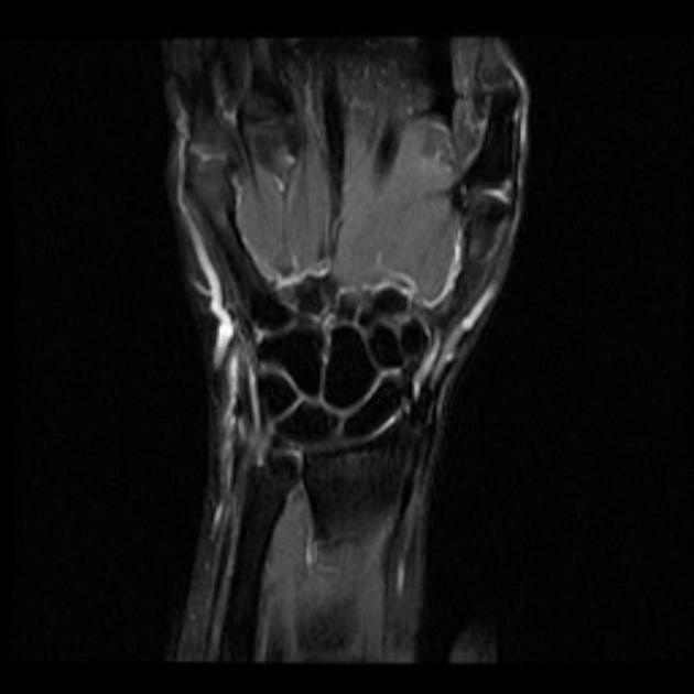 Coronal Section Of Tfcc Anatomy Ecu Extensor Carpi Ul vrogue.co