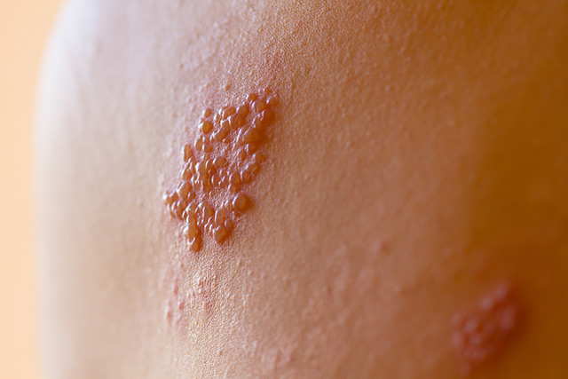 Vacina contra Herpes é responsável por causar grande numero de doenças Vacina contra Herpes é responsável por causar grande numero de doenças