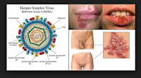 Cara Ampuh Untuk Menghilangkan Penyakit Herpes Genital