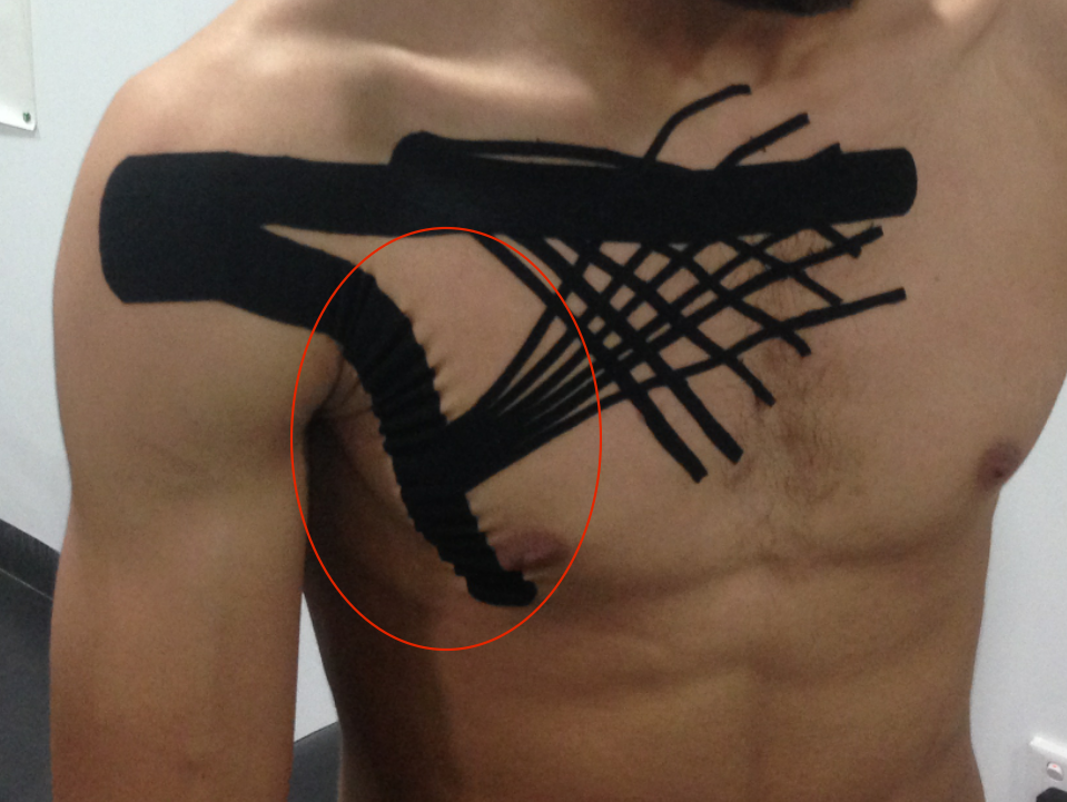 Тейп на ребро. Кинезио тейп при переломе ребра. Кинезио тейп межреберная невралгия. Тейп на ребро. Тейп на ребро.