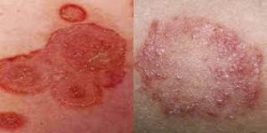 Image OBAT UNTUK KURAP DARI BAHAN ALAMI YANG MANJUR