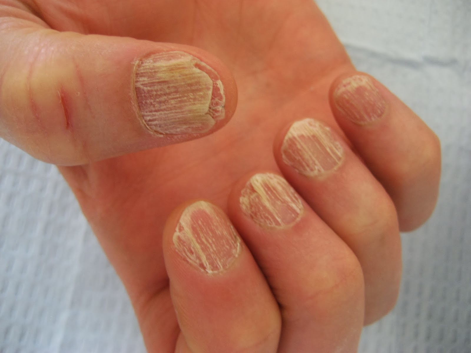 Twenty-Nail Dystrophy Originating From Lichen Planus