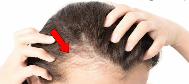 How to Prevent Hair Loss after Pregnancy Hair Loss After Pregnancy Home Remedy NaturalRemedies