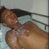 Piden ayuda para joven electrocutado en Estelí.