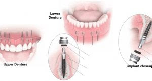 Trồng răng Implant có nguy hiểm hay không?