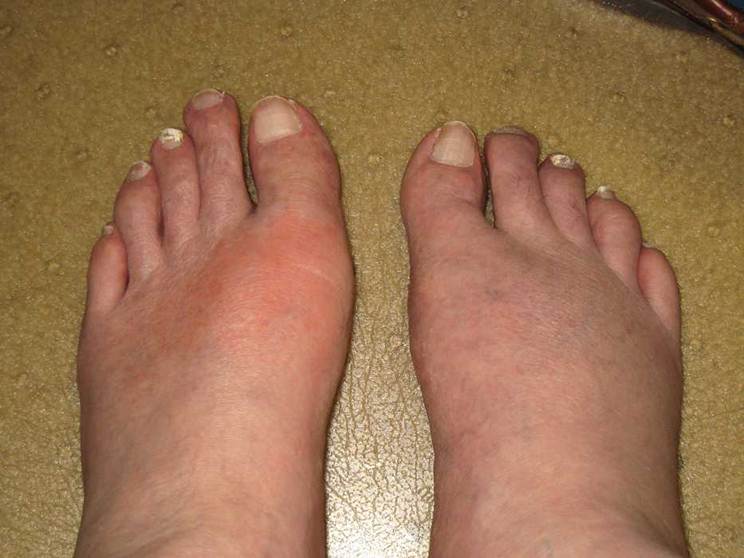 Tophi as an initial manifestation of gout