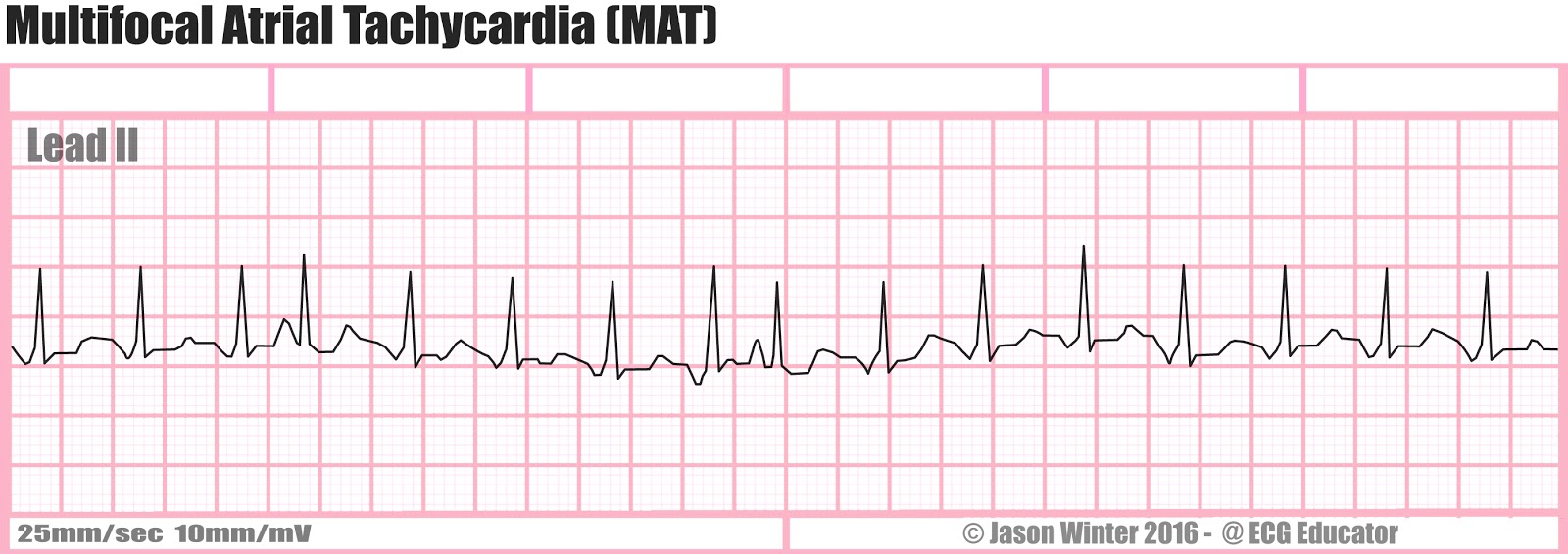 girl from jessie naked ecg rhythm strip for atrial fibrillation
