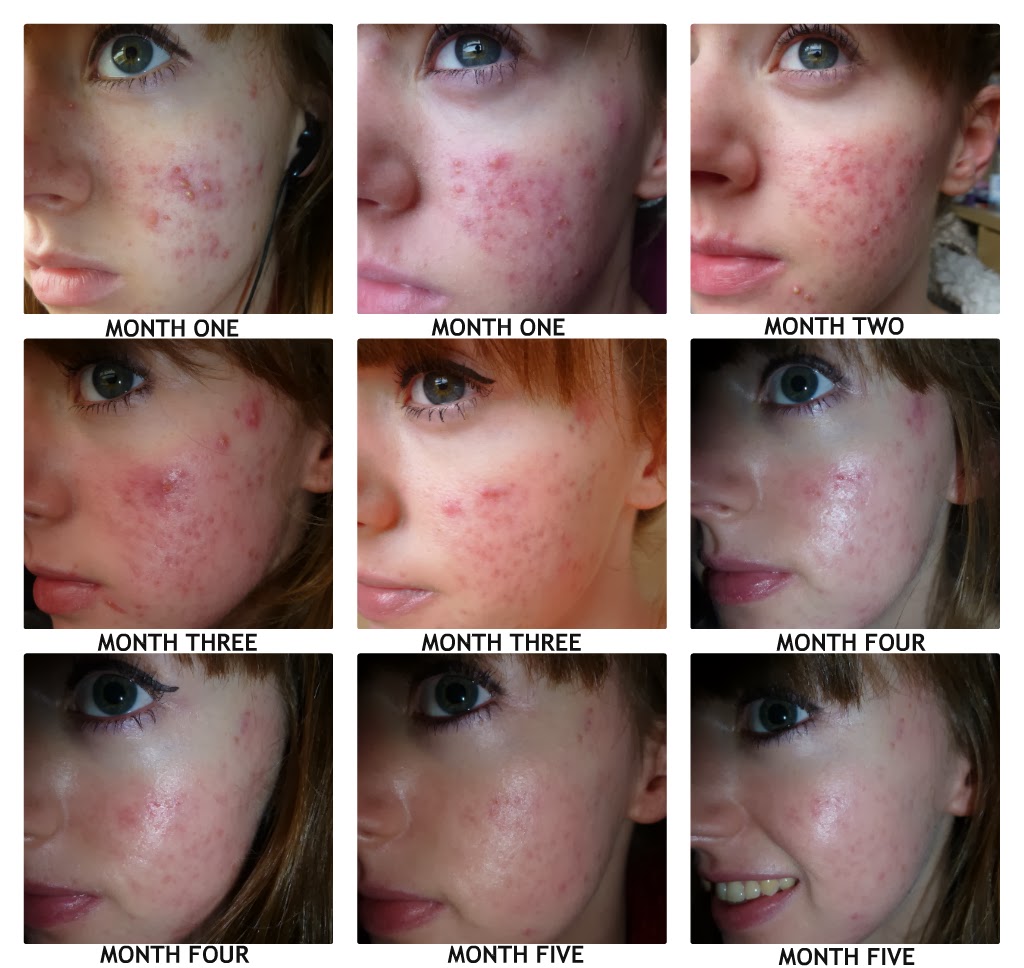 http://4.bp.blogspot.com/-mHW9OUqxdvo/Un1g0ff9NZI/AAAAAAAAAqA/45PcmGHqXVQ/s1600/ROACCUTANE+PROGRESS.jpg