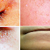 How to Get Rid of a Cyst Fast, Naturally at Home, Without Surgery