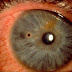 Corneal Infiltrates Images, Symptoms, Causes, Treatment, Healing, Time