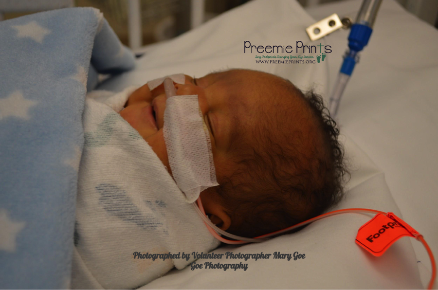 Brain Bleed Grade 1 Brain Bleed Preemie