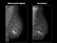 mammografia