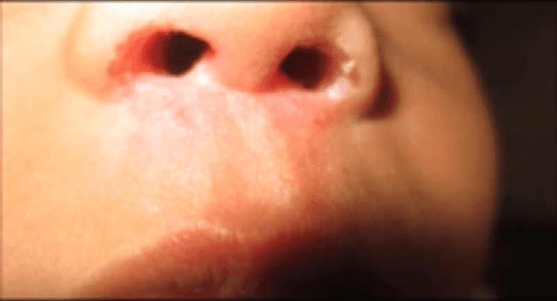 Nasal-vestibulitis
