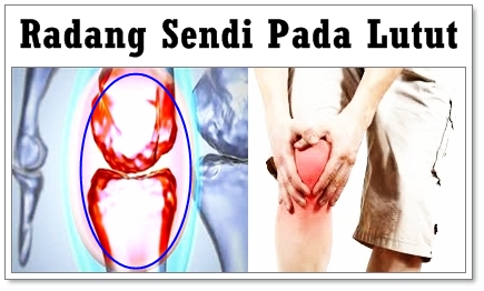 Cara Mengobati Radang Sendi Pada Lutut Cara Mengobati Radang Sendi Pada Lutut