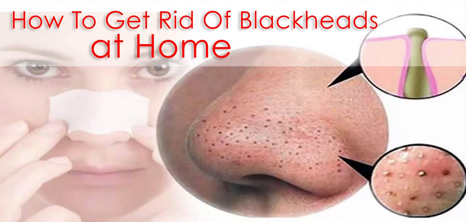 How To Get Rid Of Blackheads On The Chin Fast At Home Easy Hacks