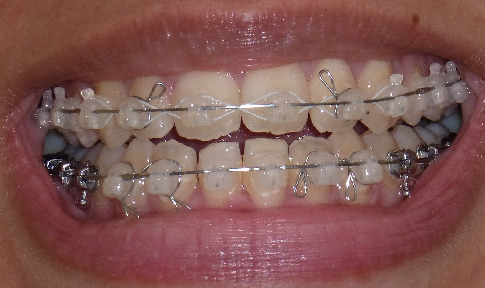 My Damon Clear Braces Week 21 Wire change to 'square' wire and new hooks