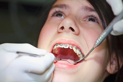 Lỗi kỹ thuật niềng răng bị sưng lợi bạn cần đề phòng 2