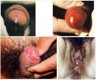 Image Kencing Keluar Nanah Saat Pagi