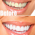 How To Have Natural White Teeth in 3 minutes (Works 100%)