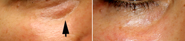 Eyelid Surgery by Prof Dr CN CHUA 蔡鐘能: Complications of Tear Trough ...