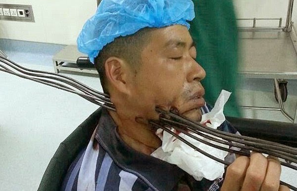 Parah Tercucuk 6 Batang Besi Di Leher La iye Ker Parah Tercucuk 6 Batang Besi Di Leher La iye Ker