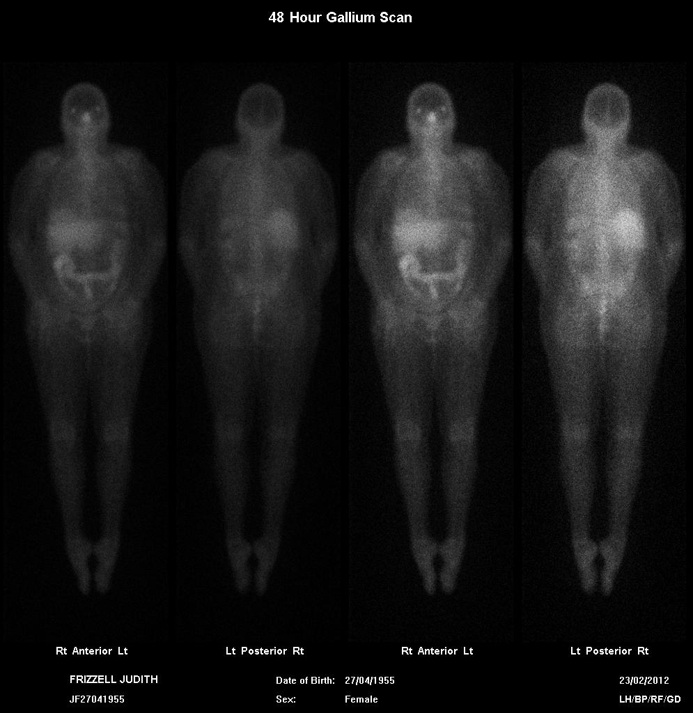 Days of our Lives: Australian Version: Gallium Scan Results