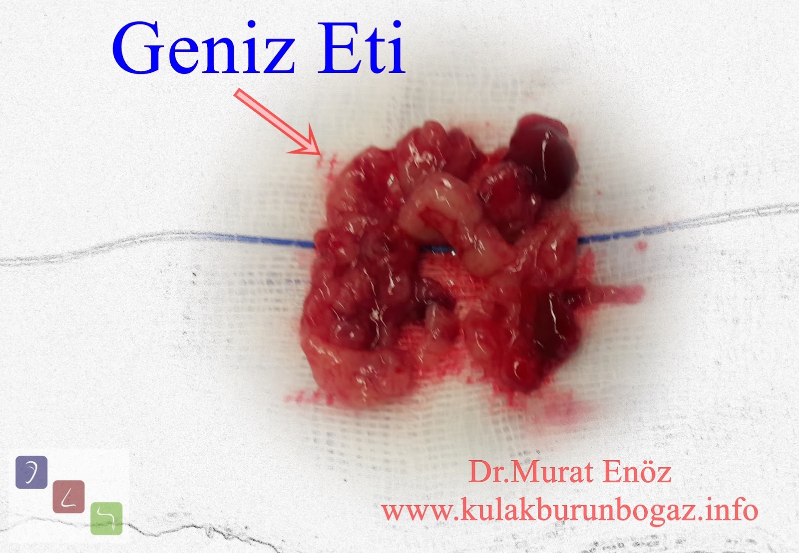 Geniz Eti Ameliyatı Sonrası, Geniz Etinin Tekrar Büyümesinin Nedenleri