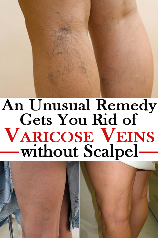 rid veins varicose remedy without unusual gets vein scalpel natural know credit remove help
