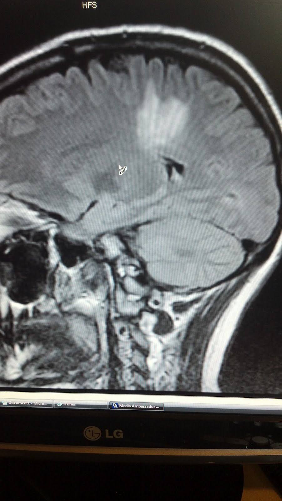 Tumefactive Multiple Sclerosis: MRI pics January