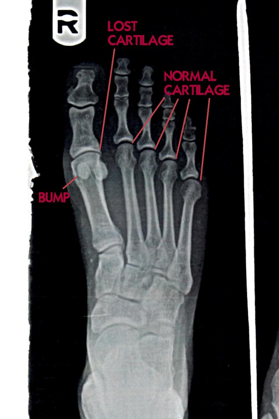 Kim Runs Miles With Smiles What is Hallux Rigidus & What Can I Do?