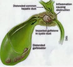 Natural Ways To Pass Gallstones Natural Ways To Pass Gallstones