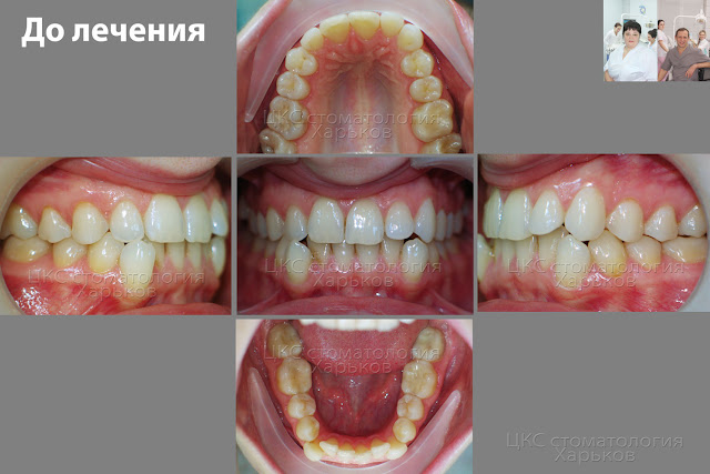 Прикус до ортодонтического лечения Прикус до ортодонтического лечения